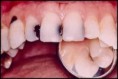 /album/dental-cavities/dental-cavity-4-jpg/